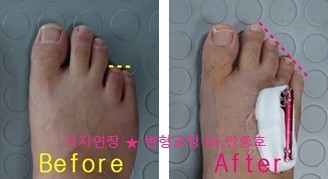  발가락 단지증