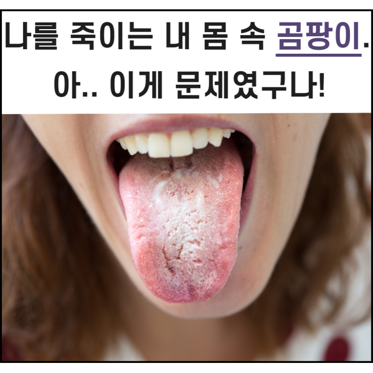  나를 죽이는 내 몸 속 곰팡이. 아.. 이게 문제였구나! 칸디다증 탈출법