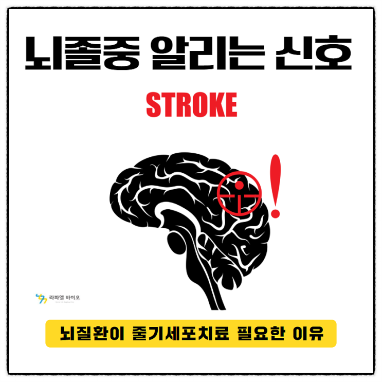  뇌졸중 알리는 신호, 뇌질환을 줄기세포치료가 필요한 이유