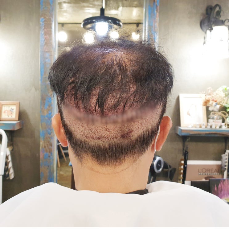  대량 모발이식 뒤통수 삭발 커버 방법