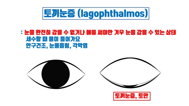  대표적 쌍수부작용인 토끼눈증의 원인 2가지 !!!