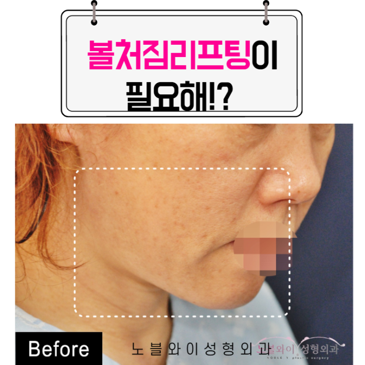  볼처짐리프팅 효과가 엄청나
