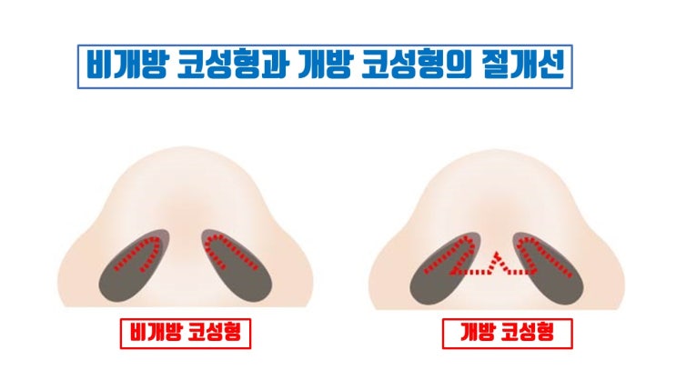  비개방 코수술 하지 마세요 코성형은 꼭 개방 코수술로!!!