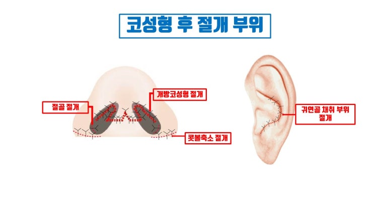  코수술 실밥 제거는 절대로 시기 늦추면 안되는 코수술 사후 관리