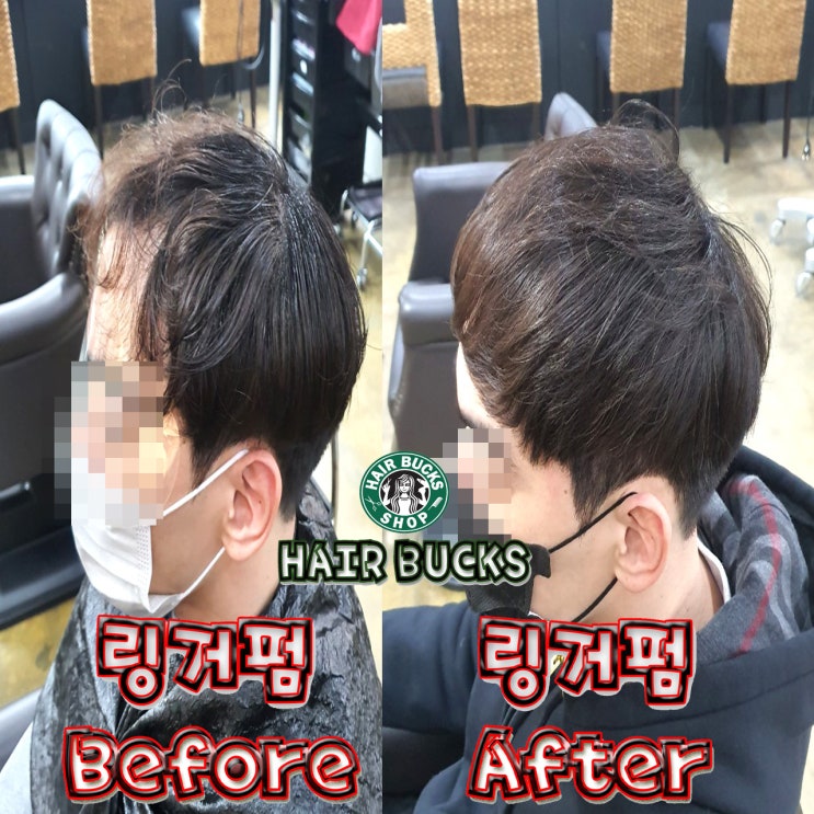  M자 탈모커버 시술과정 ~!!
