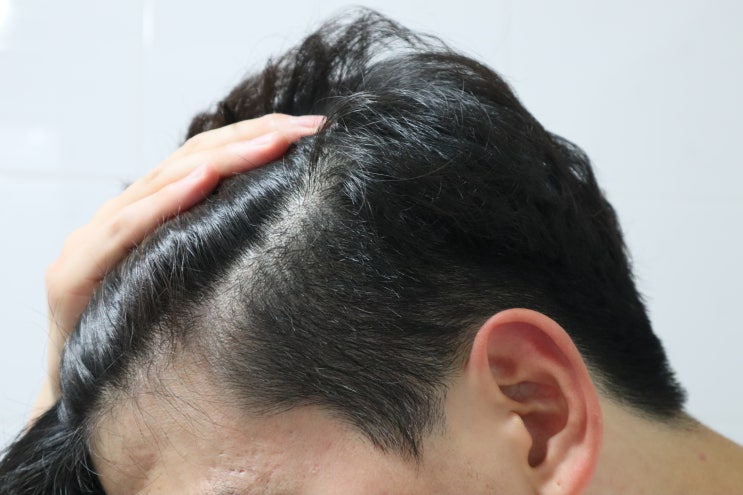  지성두피를 위한 탈모에좋은샴푸, 테라피션