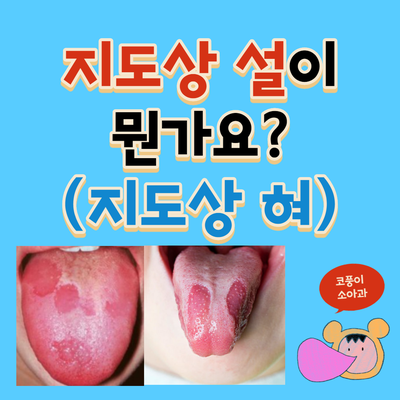  지도상 설(지도상 혀)이 뭔가요?(원인, 치료, 음낭 혀)