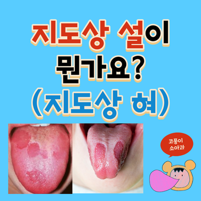 지도상 설(지도상 혀)이 뭔가요?(원인, 치료, 음낭 혀)