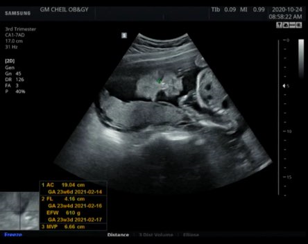 [임신일기] 임신24주 배크기 임산부 임당검사 통과 후기 + 초음파, 전날 식단 기록