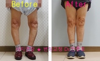  심한 오다리때문에 생긴 퇴행성 관절염