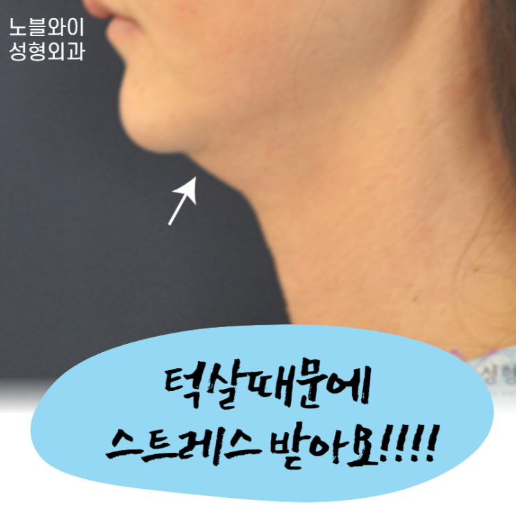  턱지방흡입 보다 이중턱수술 왜