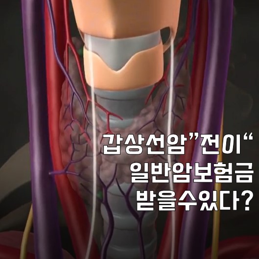  갑상선암 전이된 경우 일반 암?