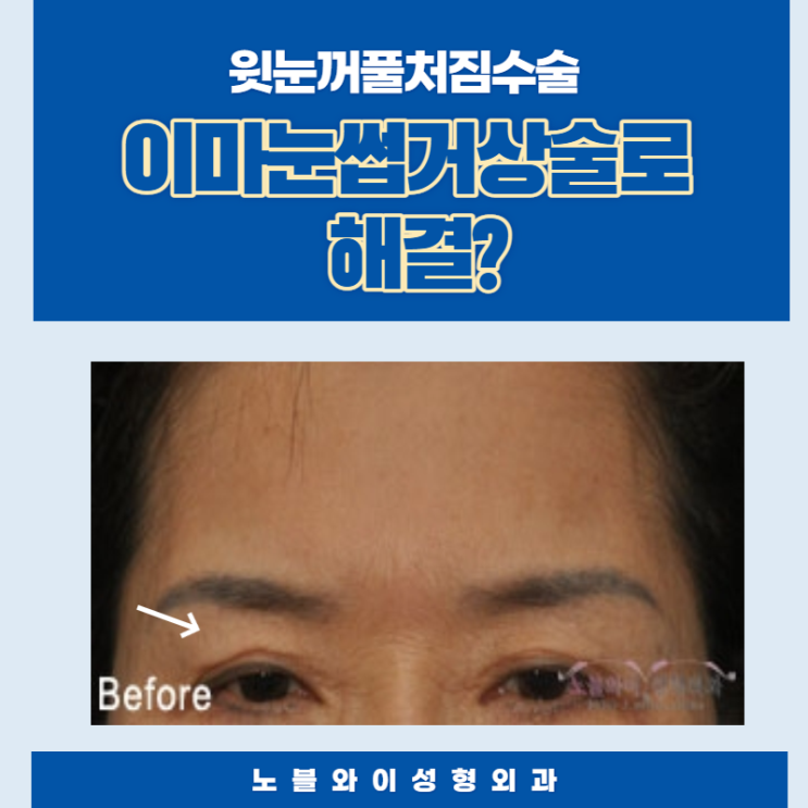  윗눈꺼풀처짐수술 이마눈썹거상술 어때