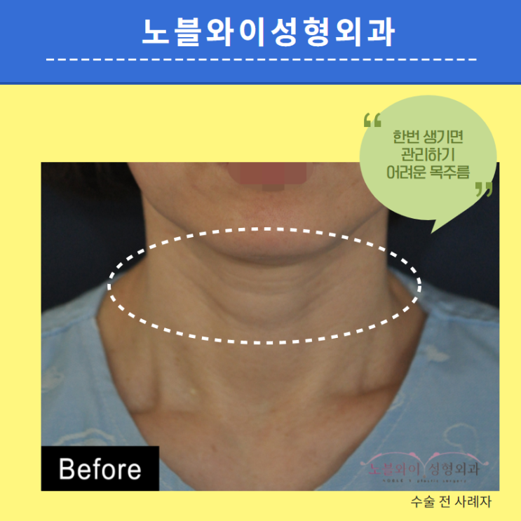  목주름제거술 효과가 이정도였나