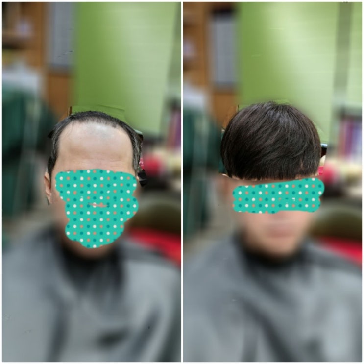  M자이마탈모 리바이탈증모술로 완벽커버10개월차~ [춘천가발 ㆍ헤어증모술전문점]