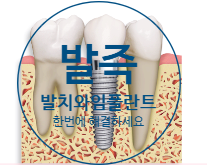  당감동치과 발치와 임플란트를 동시에