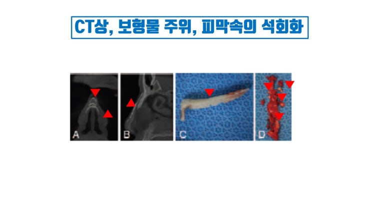 실리콘 석회화 현상 반드시 코수술 부작용이라고 말할 수는 없어요.