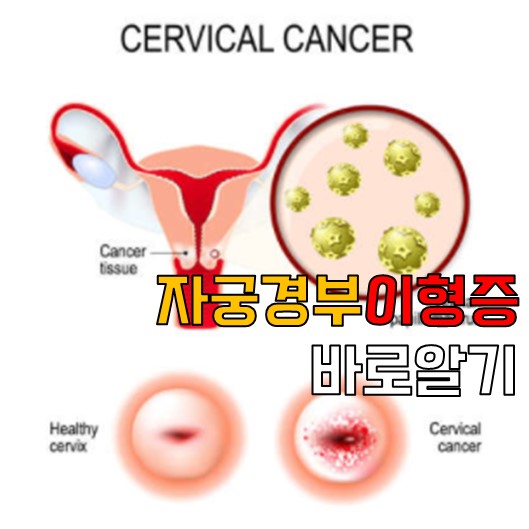  자궁근종 이형성증 보험금청구