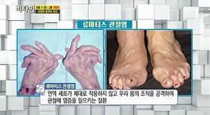 류마티스관절염 원인증상치료 자가면역질환:오메가3 msm복용효능 간호문헌케이스