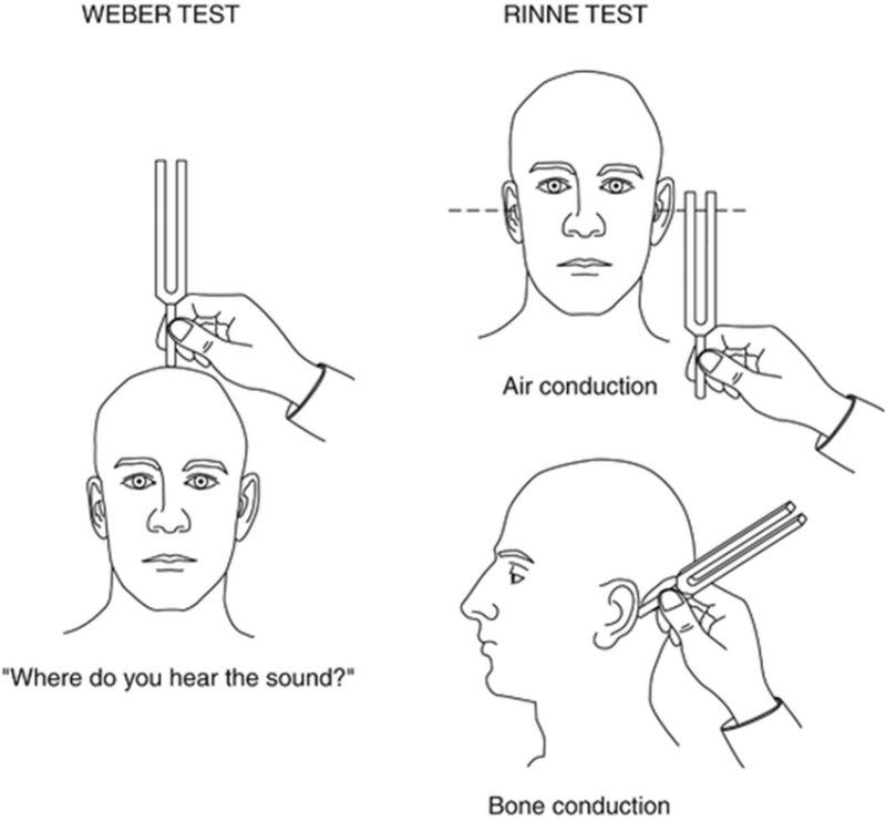 잠실 보청기 / 음차 검사 (Tuning fork tests) : 네이버 블로그