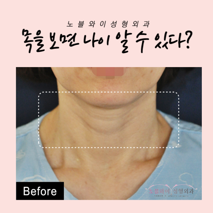  목주름거상 어려보이는 이유가 이거네