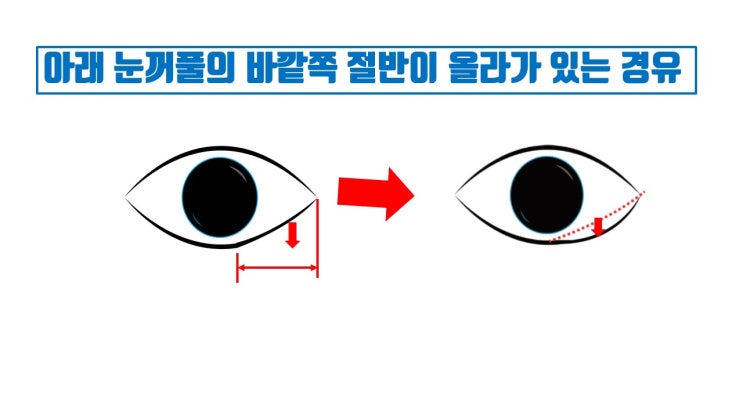  밑트임은 원리를 알면 비절개 밑트임이 절대 안되는 이유를 알 수 있어요!!!