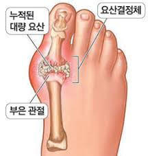 통풍 원인증상 요산결정체치료 관절염합병증:퓨린대사장애 식이요법 간호문헌고찰케이스 통풍 원인증상 요산결정체치료 관절염합병증:퓨린대사장애 식이요법 간호문헌고찰케이스