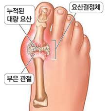 통풍 원인증상 요산결정체치료 관절염합병증:퓨린대사장애 식이요법 간호문헌고찰케이스