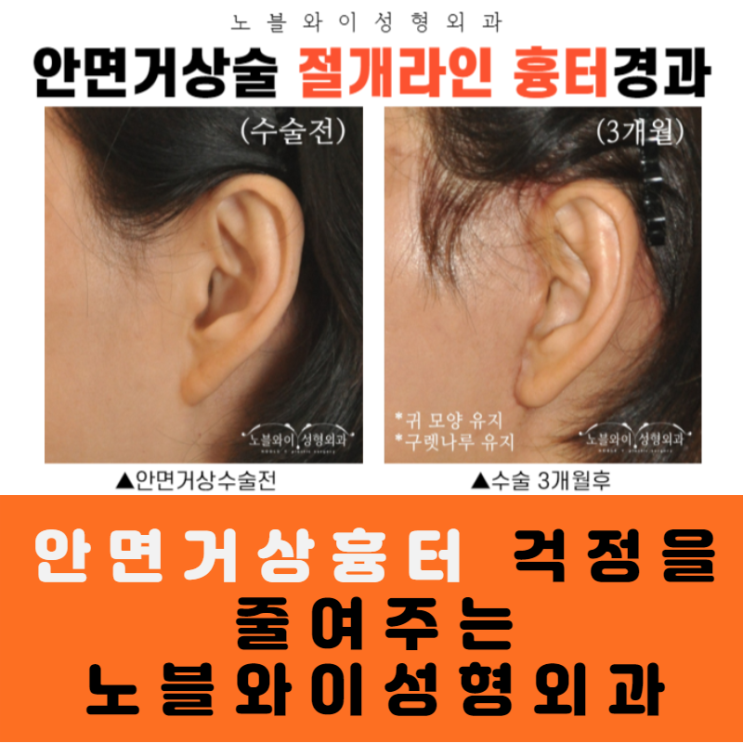  노블와이 안면거상술 안면거상흉터 걱정안돼