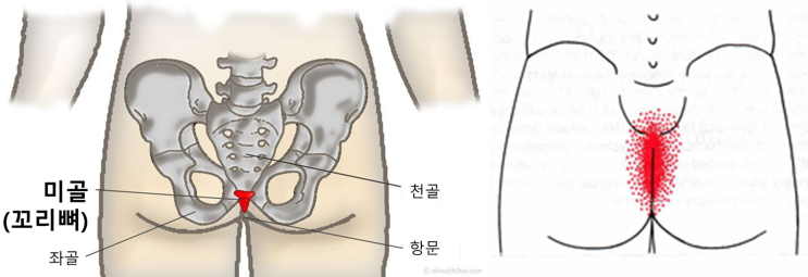  일산, 꼬리뼈가 아파요, 꼬리뼈 통증, 꼬리뼈 염좌, 미골 통증 - 미골 추나 치료 - 가로세로 한의원 일산점