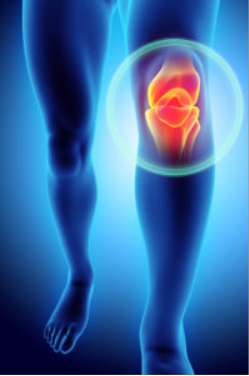 [질병정보] 연골연화증 (Chondromalacia)- 무릎에 걸리는 감기처럼 흔한 질환 (증상, 진단, 치료, 예방)