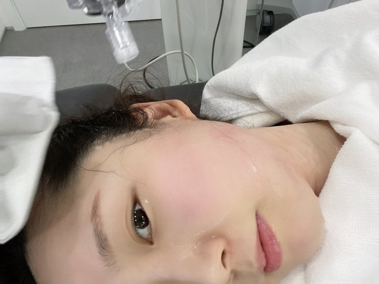  압구정피부과  인모드+에어젯 인어젯 1회차 후기