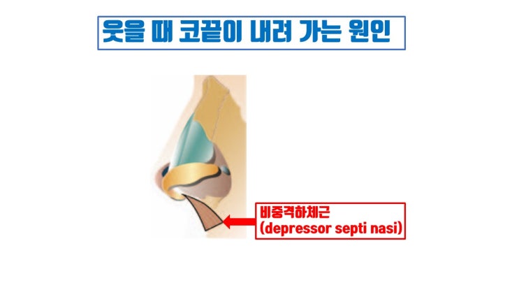  코끝 처짐이 웃을 때만 생겨요? 비주지지대를 이식해야 할까요?