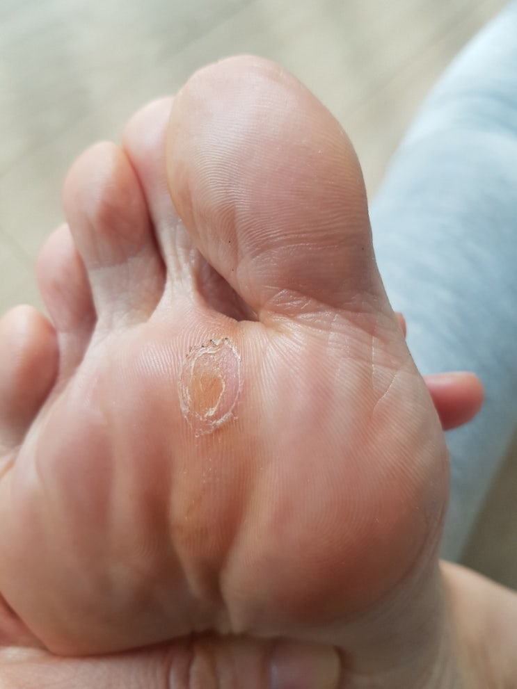 발바닥 티눈 제거 병원 갔다가 자가치료 변경 후 완쾌 꿀팁 대방출 8