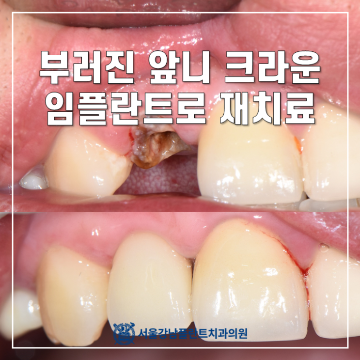  2차 우식으로 인한 오래된 크라운 치아 부러짐 - 임플란트와 지르코니아 크라운으로 (앞니 임플란트)