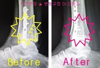  골절 수술 후유증 불유합