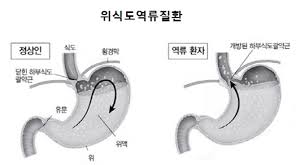  성인간호학 위식도역류질환 위십이지장궤양 소화기계약물정리 위장관삽입 간호중재