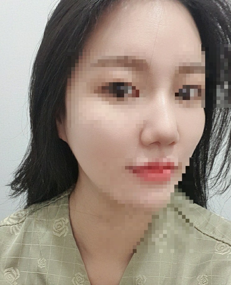 생애 첫코수술 diary(긴글 주의)