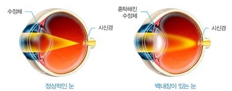  백내장 초기 증상 및 치료 방법, 수술 후 주의 사항