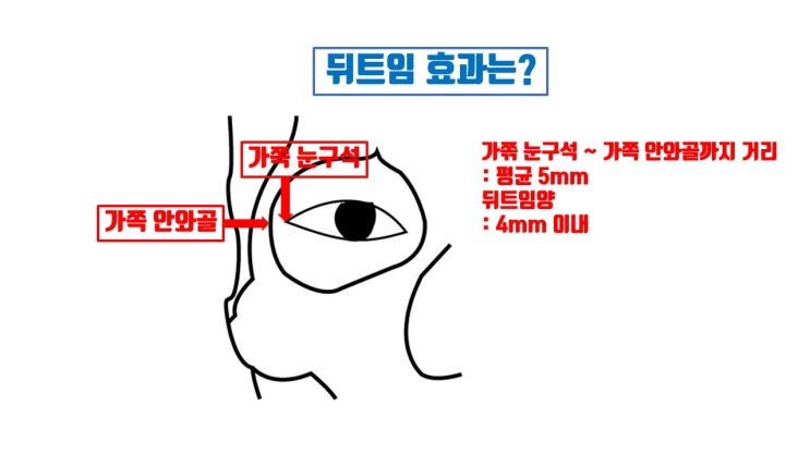  뒤트임 (뒷트임) 앞트임과 이름만 비슷할 뿐 완전히 다른 수술!!!