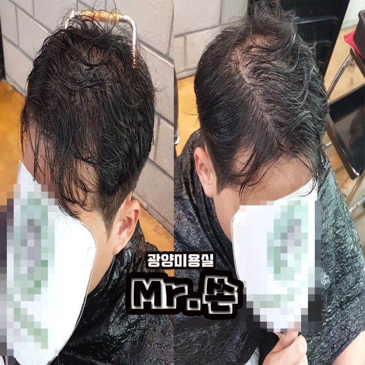  탈모있으신분이 모류교정과 스타일변화를 주면???