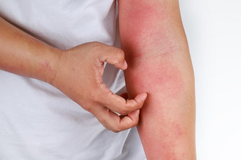 [진해피부과] 알레르기성 접촉 피부염(Allergic contact dermatitis) 1