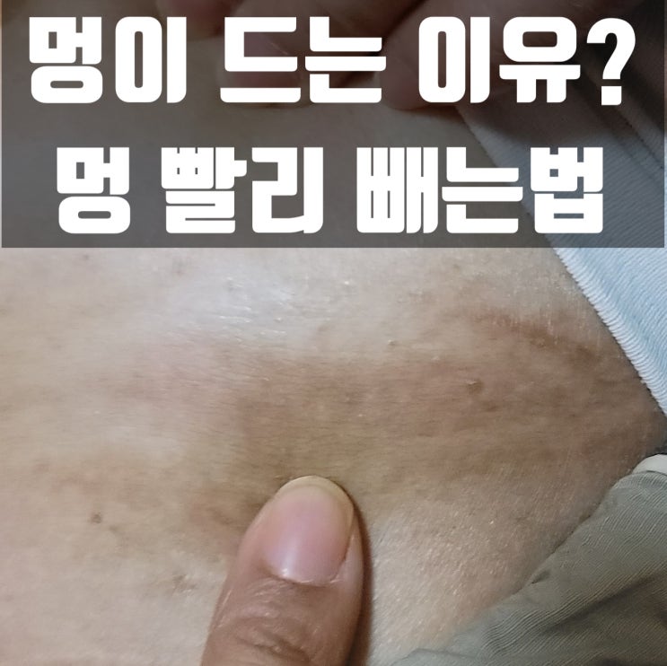 왜 멍이 드는 걸까요? 멍 빨리 빼는 법(피멍 빼는 법)