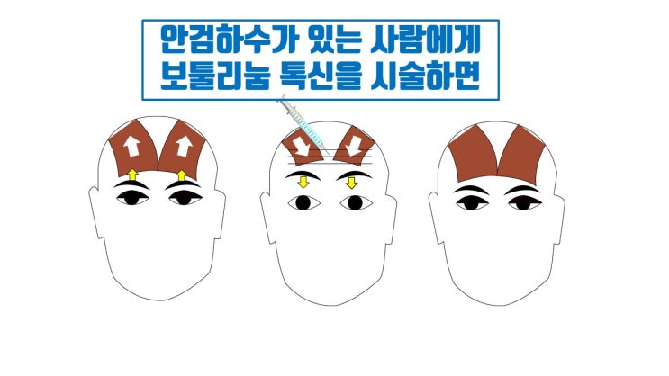  안검하수 이마주름에 이마 보톡스 시술은 언 발에 오줌 누기