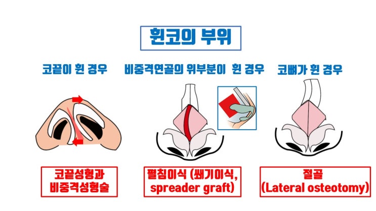  휜코수술 원인, 부위, 종류에 따라 완벽히 휜코교정 안 되는 경우가  대부분