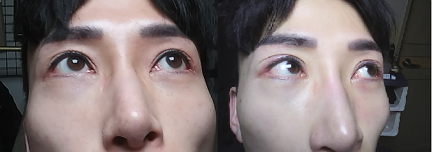 반영구 아이라인 타투 제거 드디어 3번째!! 내 금내산후기