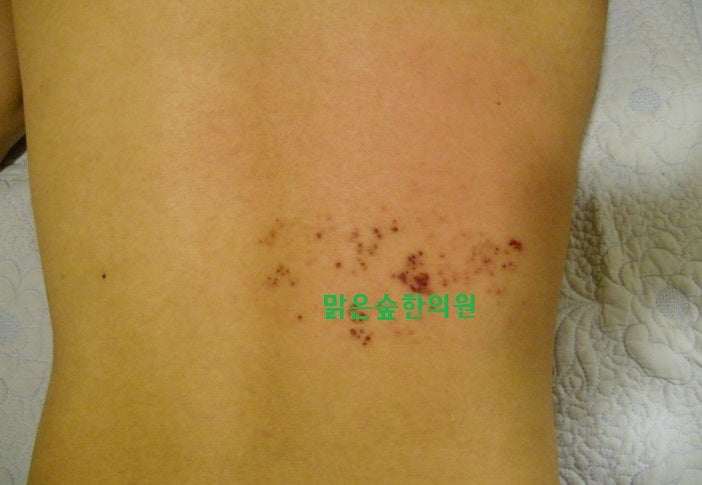 대상포진 따끔거림과 통증 - 회복 후 대상포진후신경통(대상포진후유증) 관리에 대해서 : 네이버 블로그