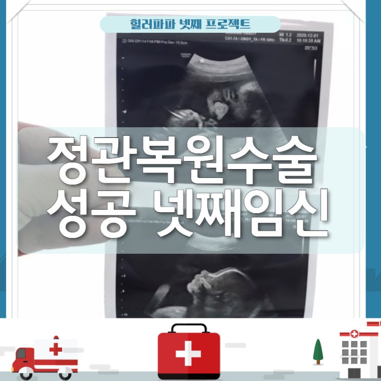 정관복원수술 성공 본인 후기-넷째 임신 7개월 정관복원수술 성공 본인 후기-넷째 임신 7개월