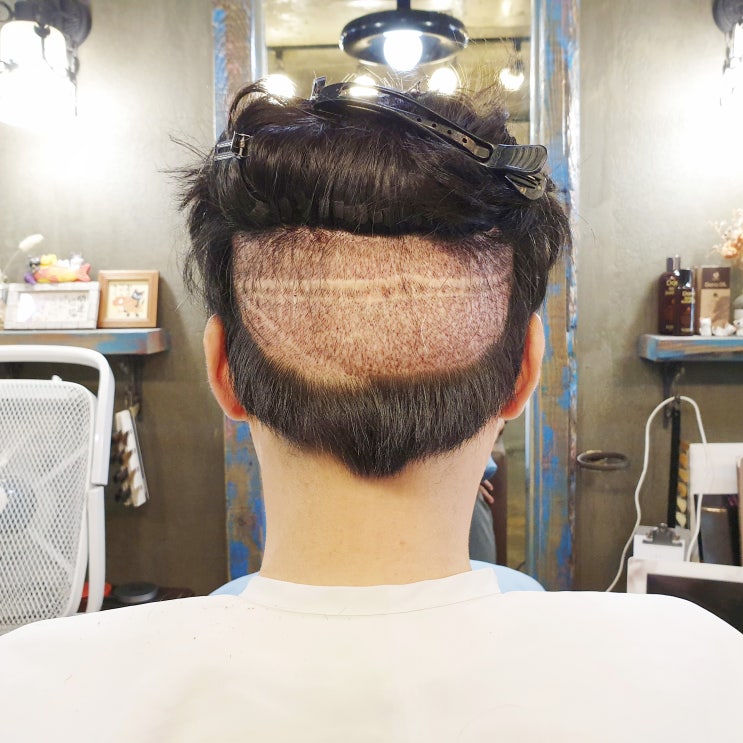  비절개 모발이식 수술 전 커트했다면?