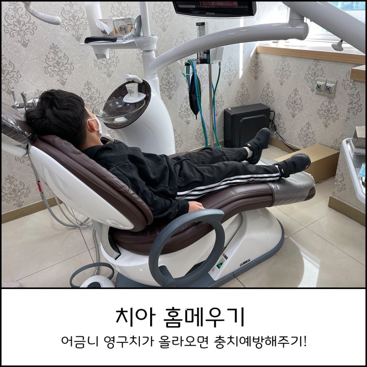  치아 홈메우기 영구치에만 하나요? 비용 및 효과 알려드려요 (충치예방 어금니 실란트)